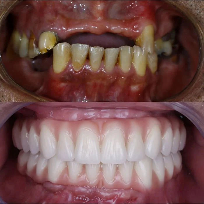 Dentadura de Silicone FIX - Ajustavel e Adaptativa